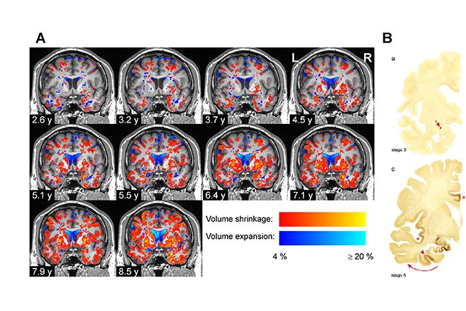 Scientists detect volume losses in brain regions associated with Parkinson's using EBRAINS