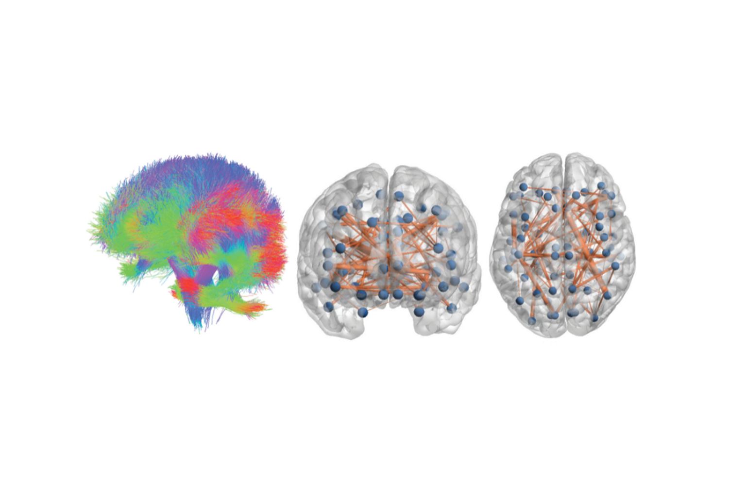Personalised Brain Models Improve Clinical Prediction In Multiple Sclerosis