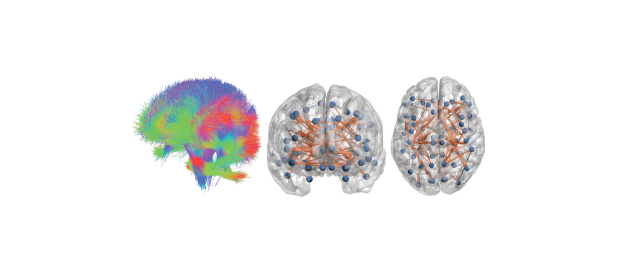 Personalised Brain Models Improve Clinical Prediction In Multiple Sclerosis