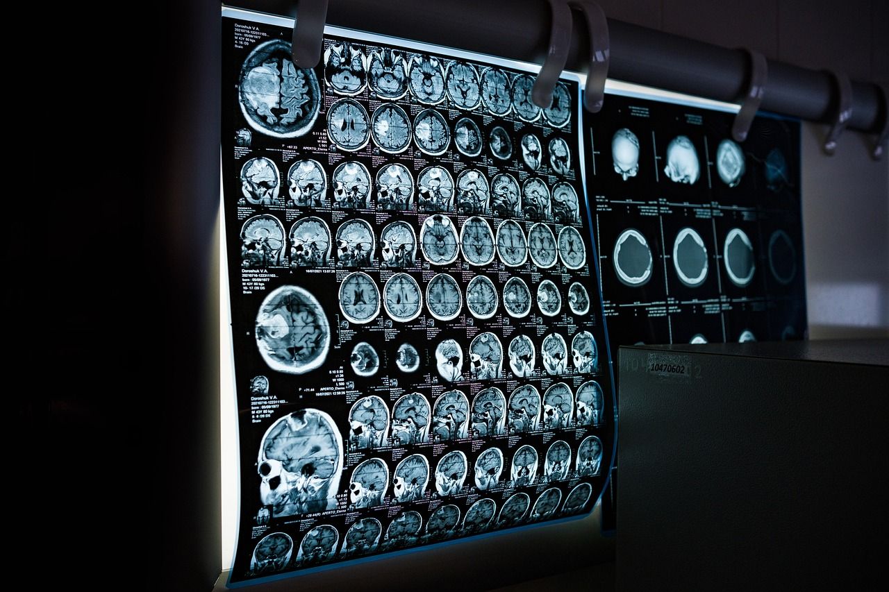 Image of brain scans