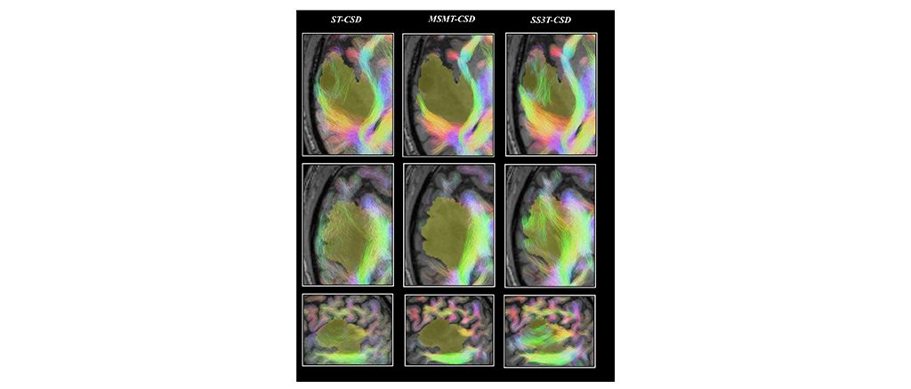 Pre- and post-surgery brain tumor data available on EBRAINS