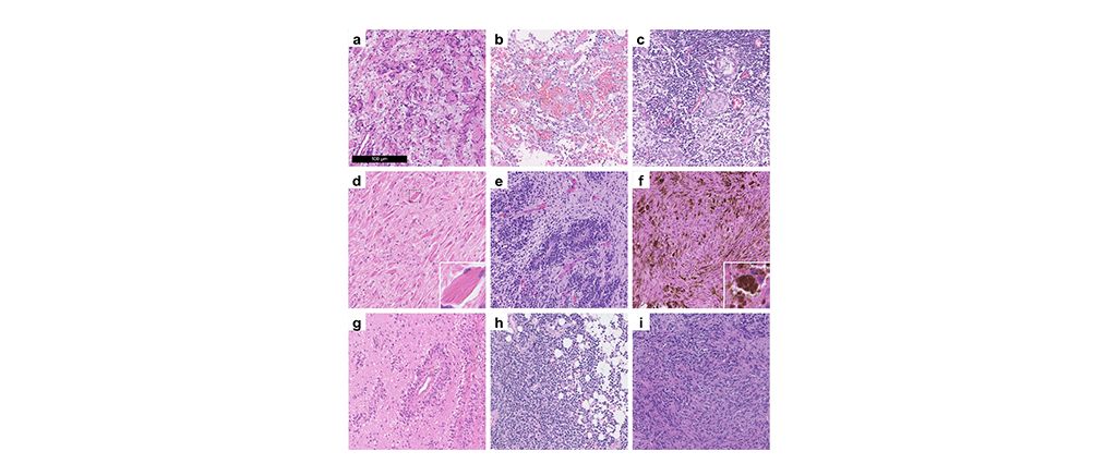 Brain tumor data now available on EBRAINS